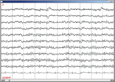 EEG